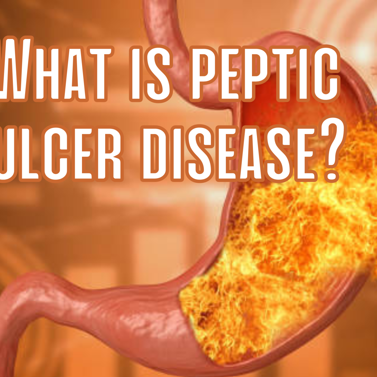 Peptic ulcer disease: Symptoms, risk factors, clinical diagnosis, and treatment